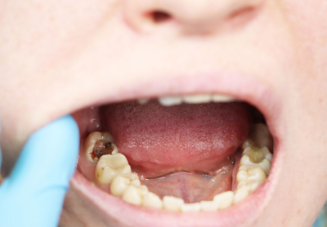imagen tratamiento endodoncia Valladolid imagen tratamiento endodoncia Valladolid