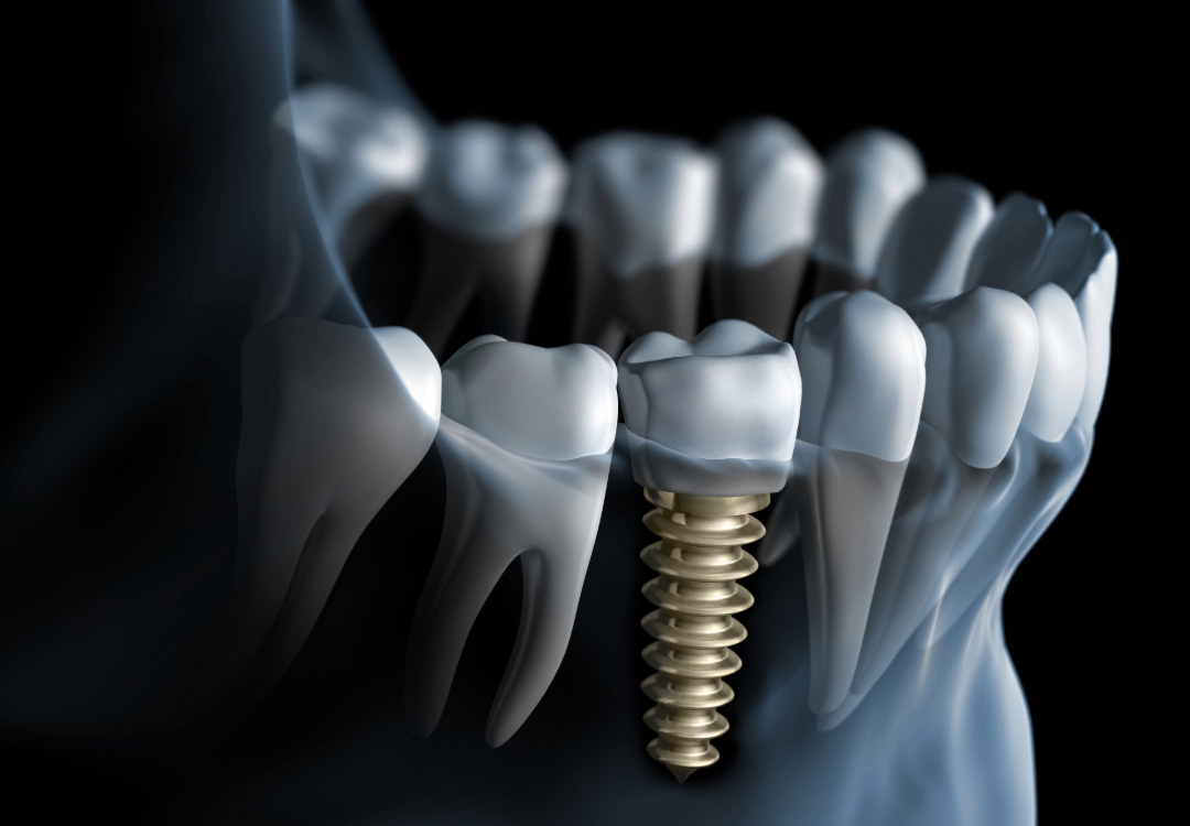 imagen implantes dentales Valladolid imagen implantes dentales Valladolid