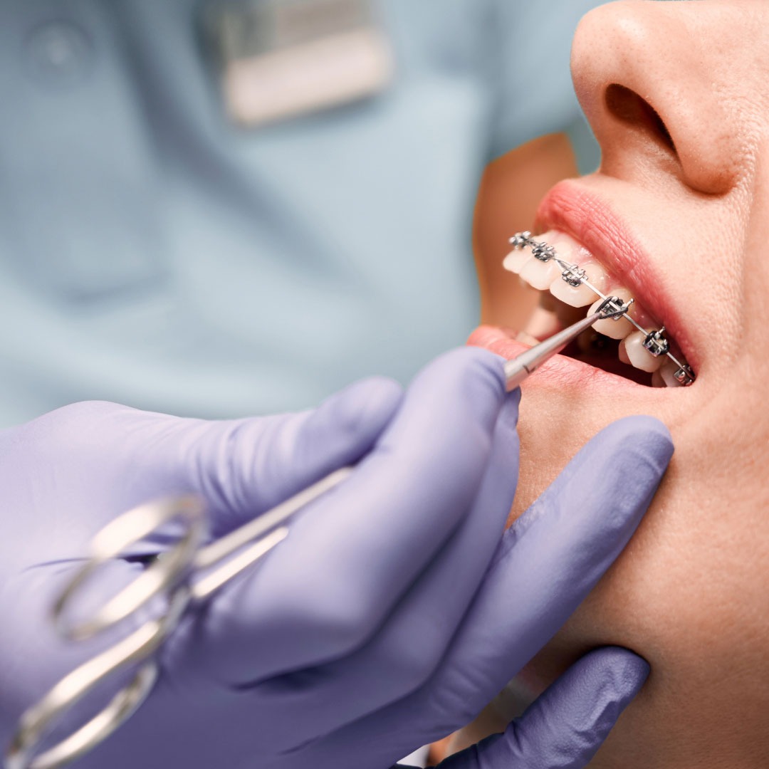 imagen ortodoncia con brackets en Valladolid